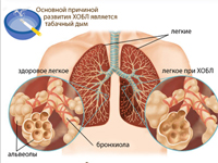 Хроническая обструктивная болезнь лёгких (ХОБЛ) | Фото с сайта pulmon.ru